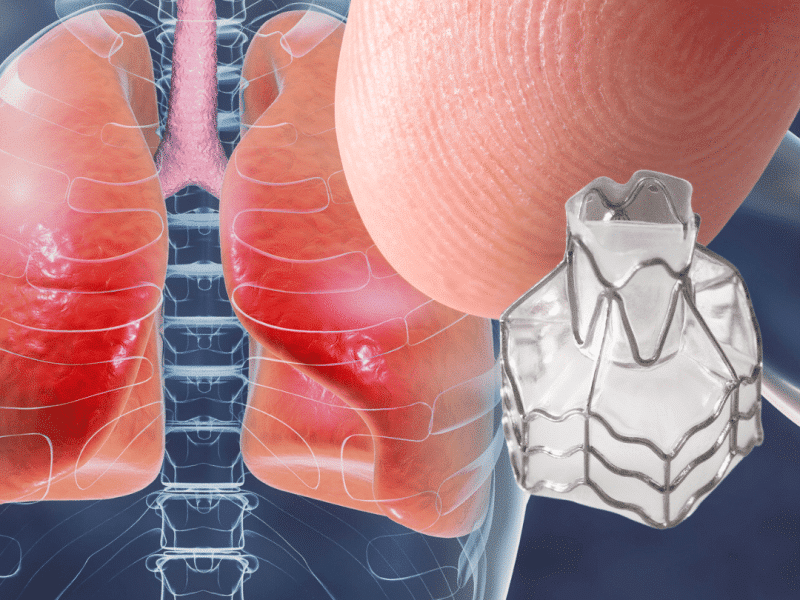 Lung Valve